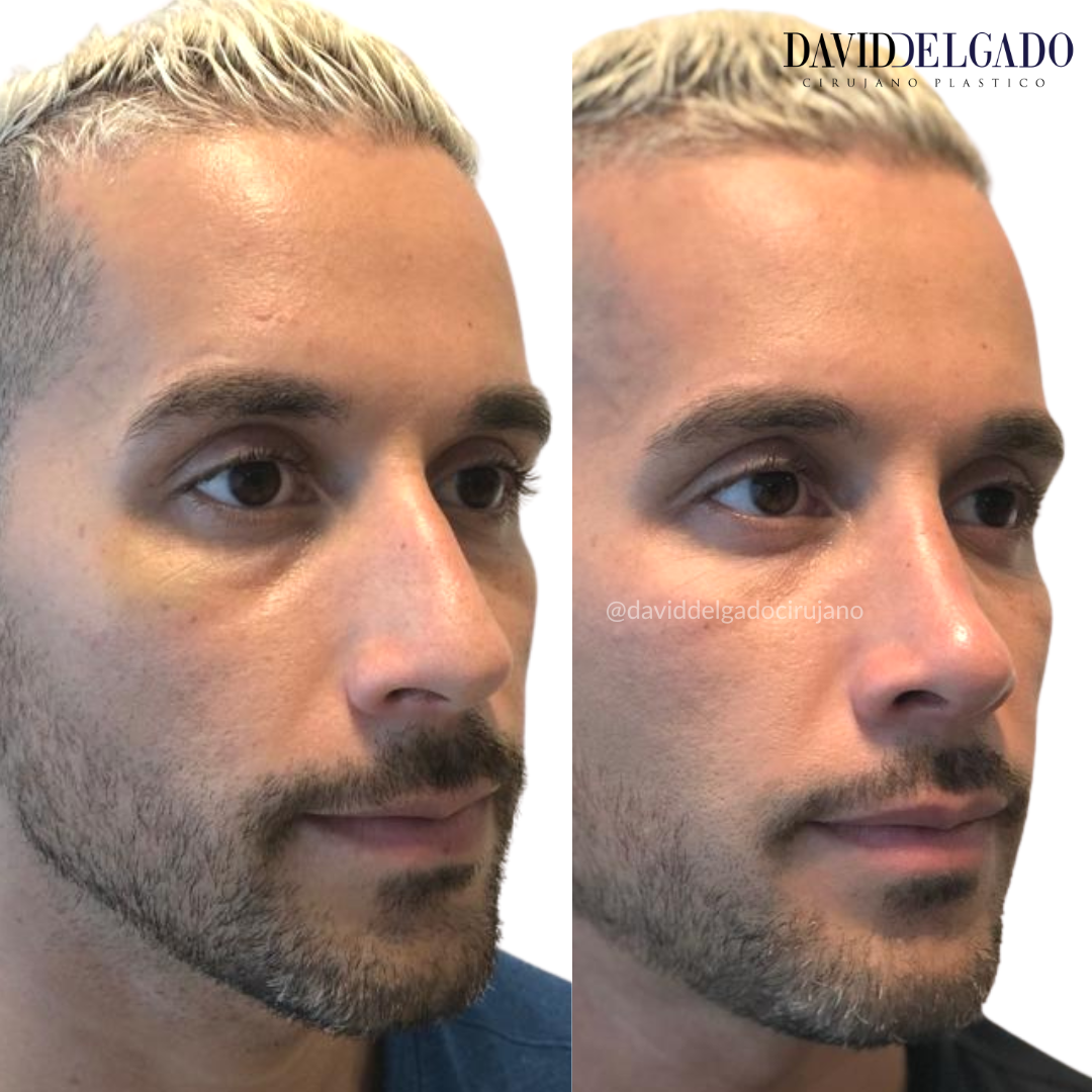 Antes y después caso Rinoplastia con el Dr David Delgado el Mejor Cirujano Plástico de Colombia