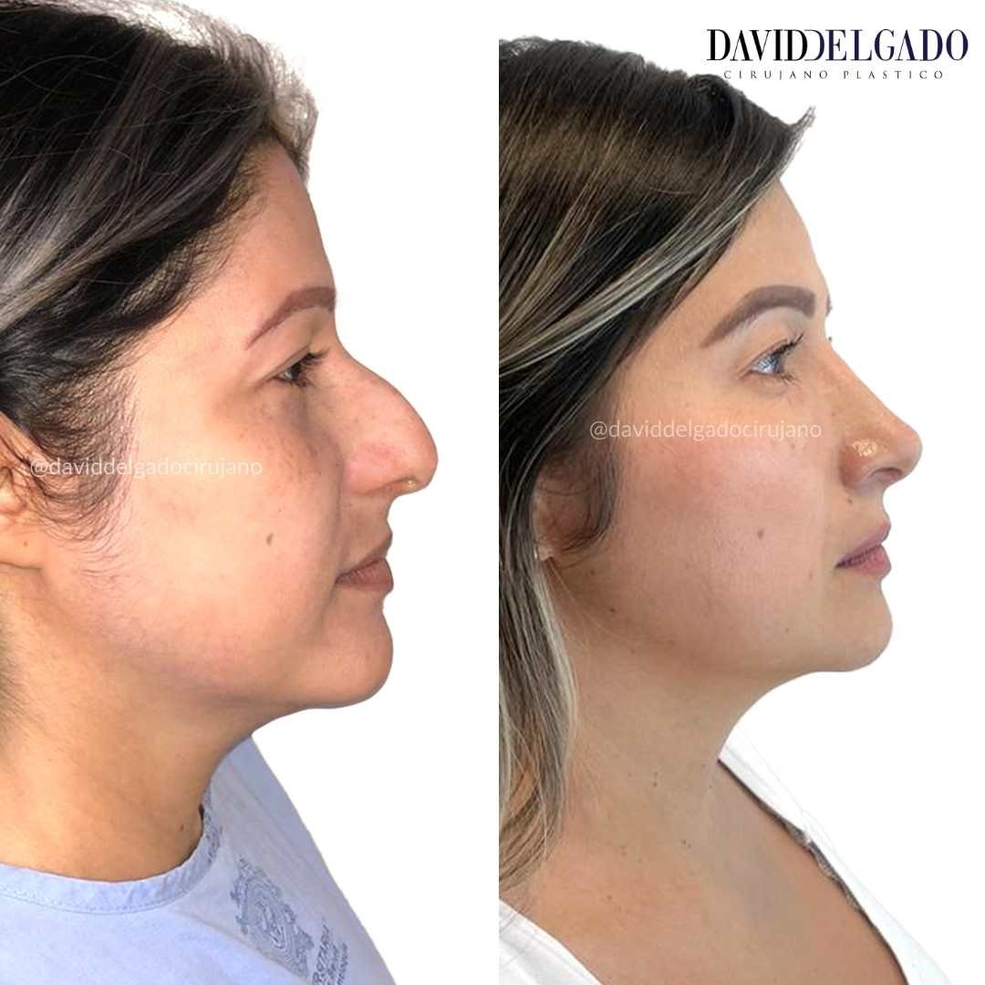 Antes y después caso Rinoplastia con el Dr David Delgado el Mejor Cirujano Plástico de Colombia