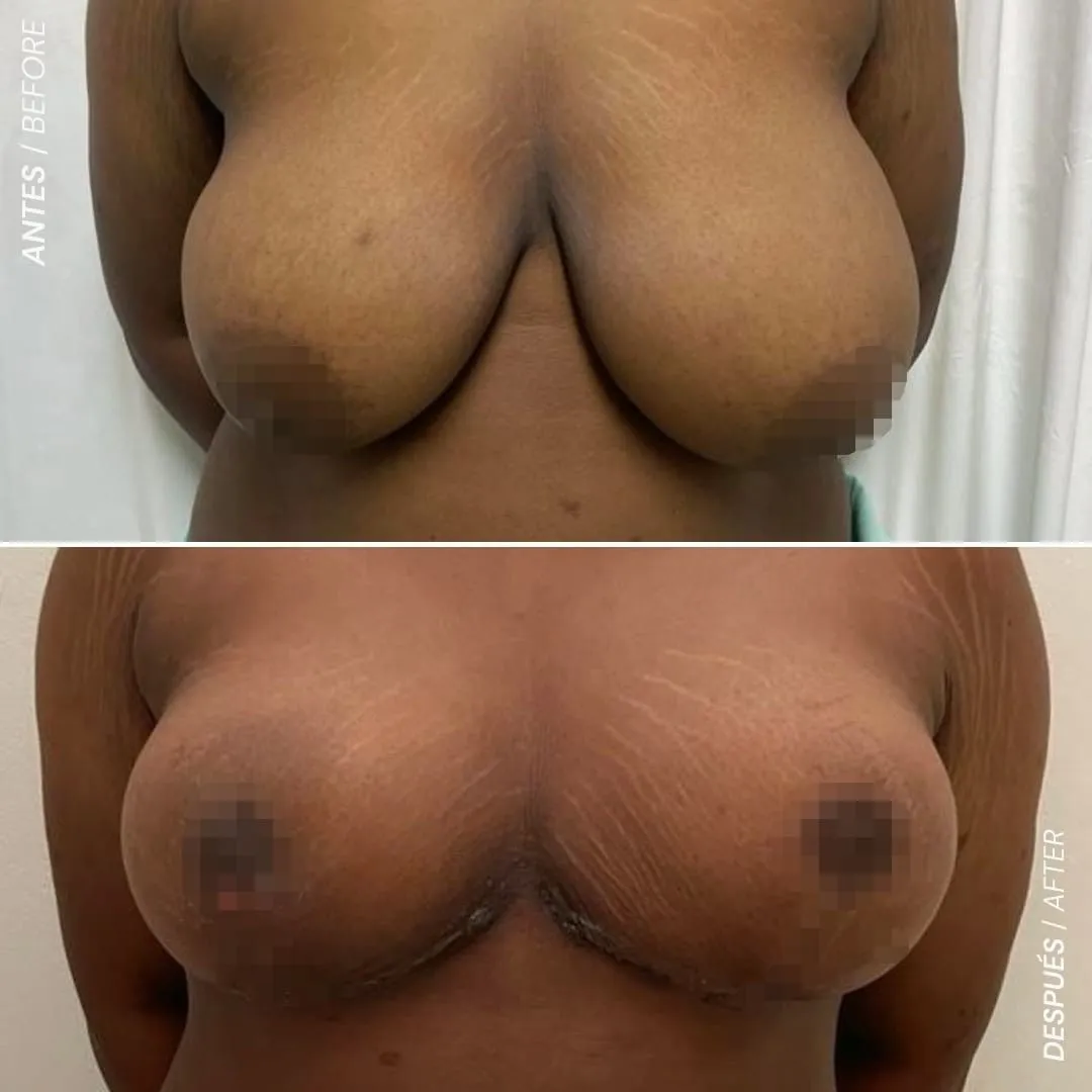 Cirugía de Senos Antes y Despues de Braquiplastia en Medellín Dr David Delgado Mejor Cirujano Plastico Colombia