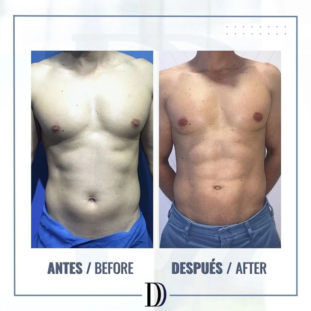 Marcación Abdominal Hombres en Medellín