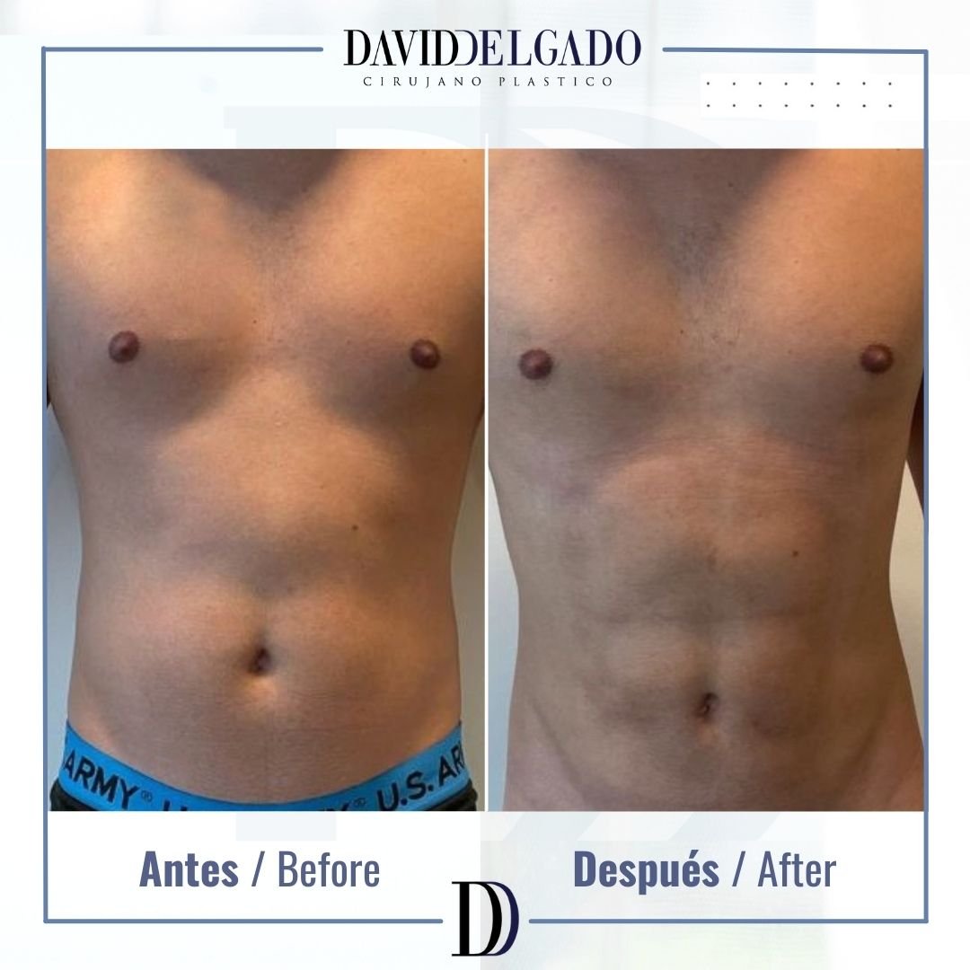 Marcación Abdominal Hombres en Medellín