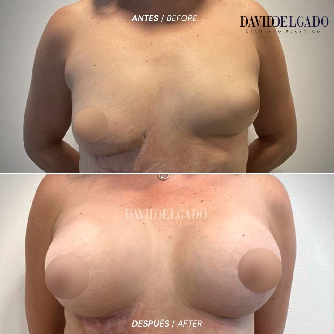 Cirugía de Senos Antes y Despues de Braquiplastia en Medellín Dr David Delgado Mejor Cirujano Plastico Colombia