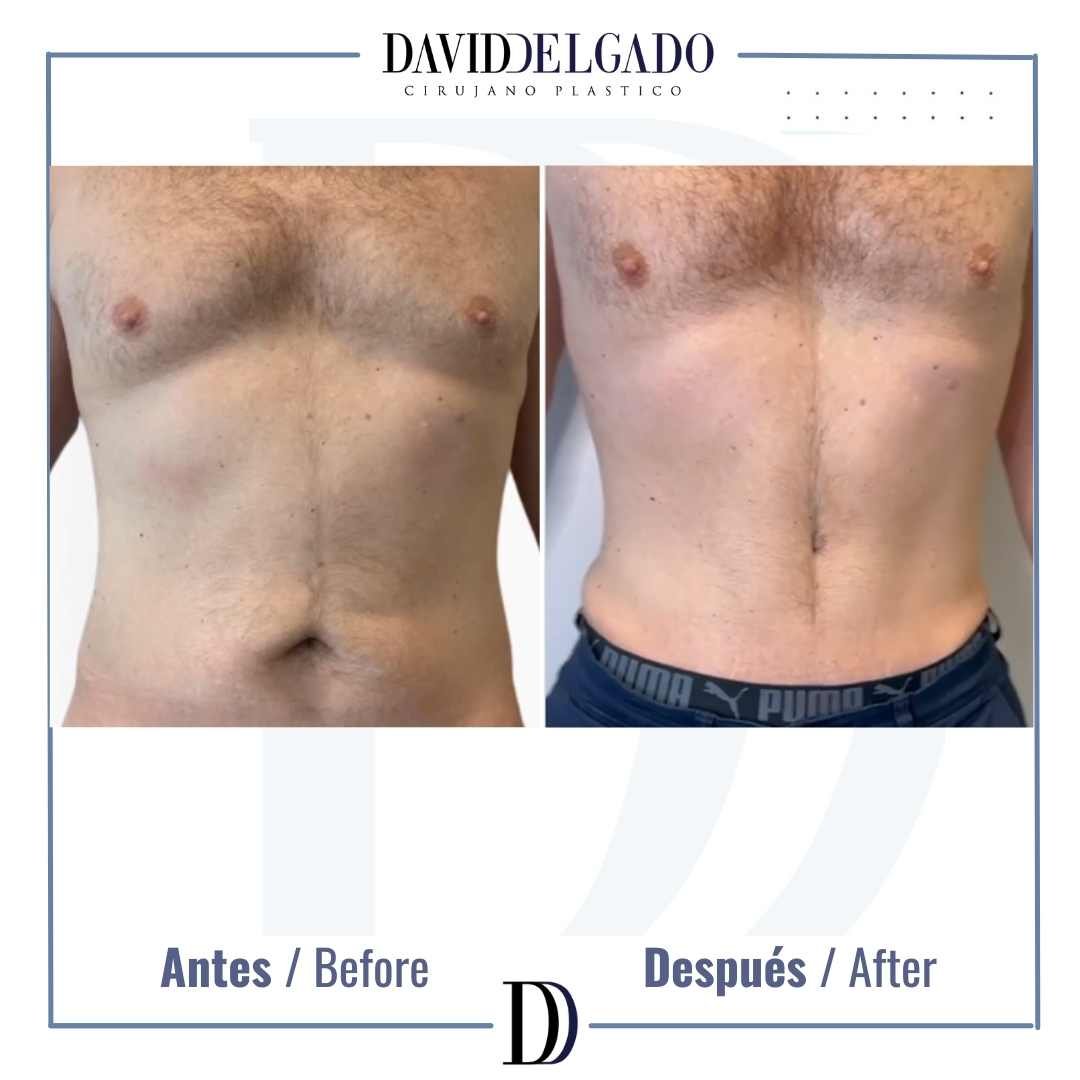 Abdominoplastia hombre fotos