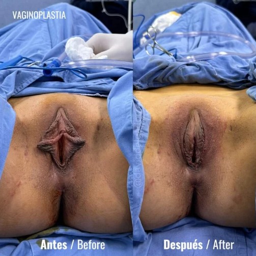 Vaginoplastia en Medellín