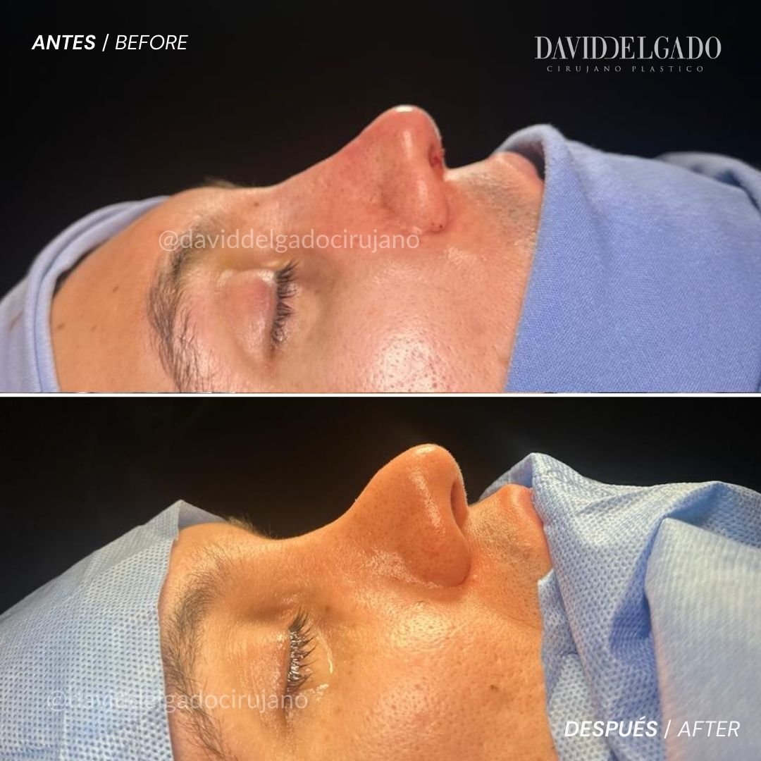 Antes y después caso Rinoplastia con el Dr David Delgado el Mejor Cirujano Plástico de Colombia