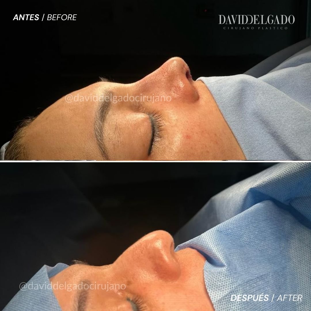 Antes y después caso Rinoplastia con el Dr David Delgado el Mejor Cirujano Plástico de Colombia