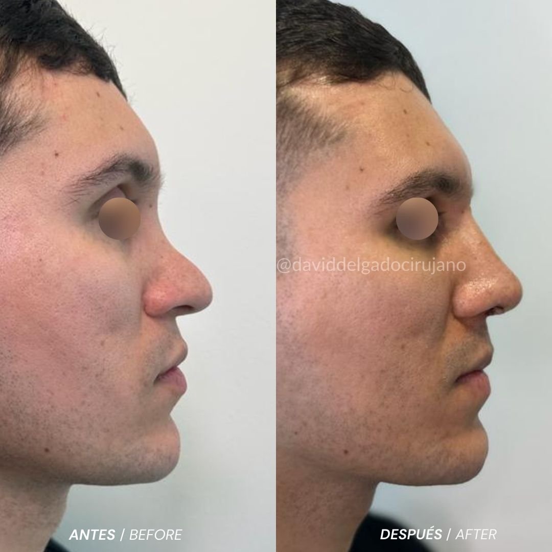 Antes y después caso Rinoplastia con el Dr David Delgado el Mejor Cirujano Plástico de Colombia