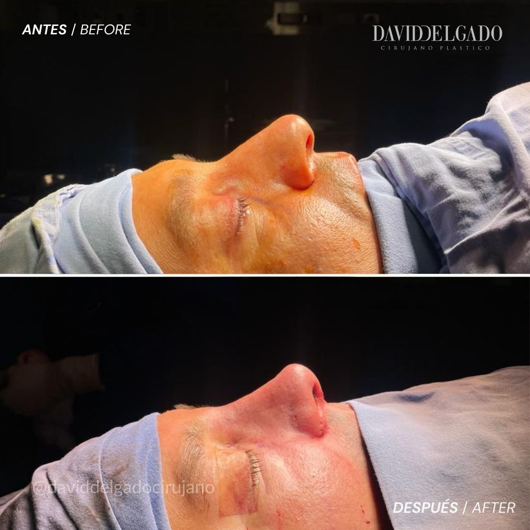 Antes y después caso Rinoplastia con el Dr David Delgado el Mejor Cirujano Plástico de Colombia