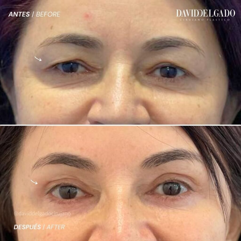 Antes y después Blefaroplastia con el Dr David Delgado Dr. David Delgado, Cirujano Plástico en Medellín