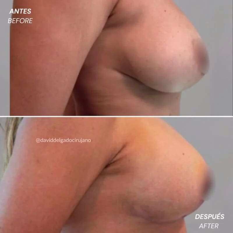 Cirugía de Senos Antes y Despues de Braquiplastia en Medellín Dr David Delgado Mejor Cirujano Plastico Colombia