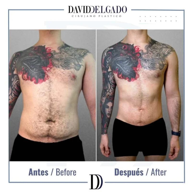 Marcación Abdominal Hombres en Medellín