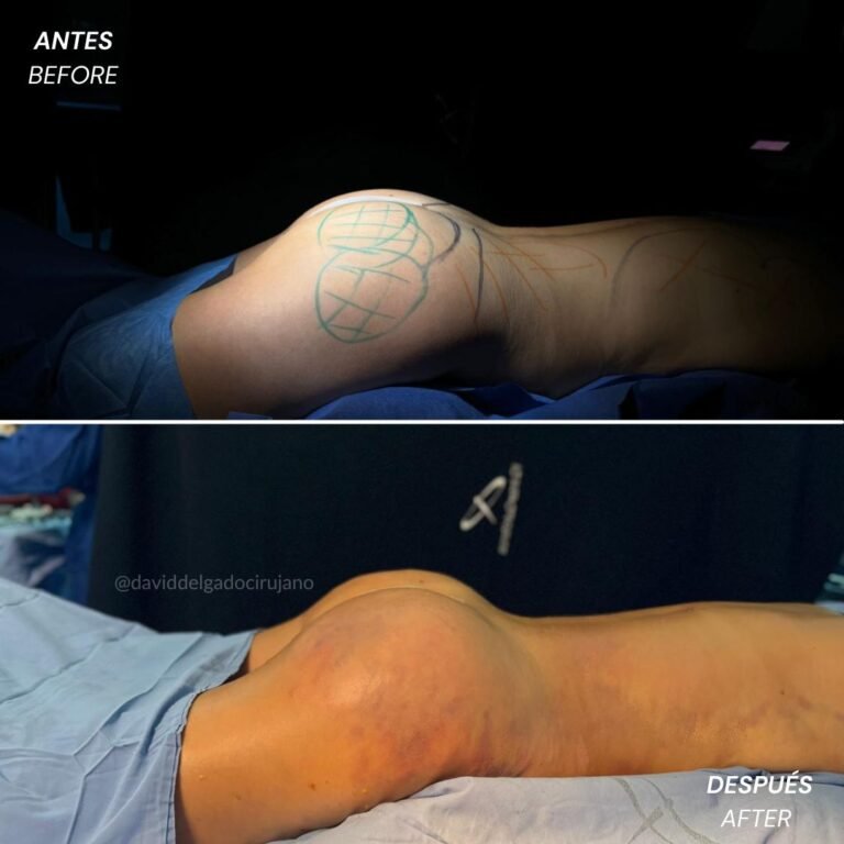 Gluteoplastia Antes y después con el Dr David delgado el mejor cirujano plástico de Medellín