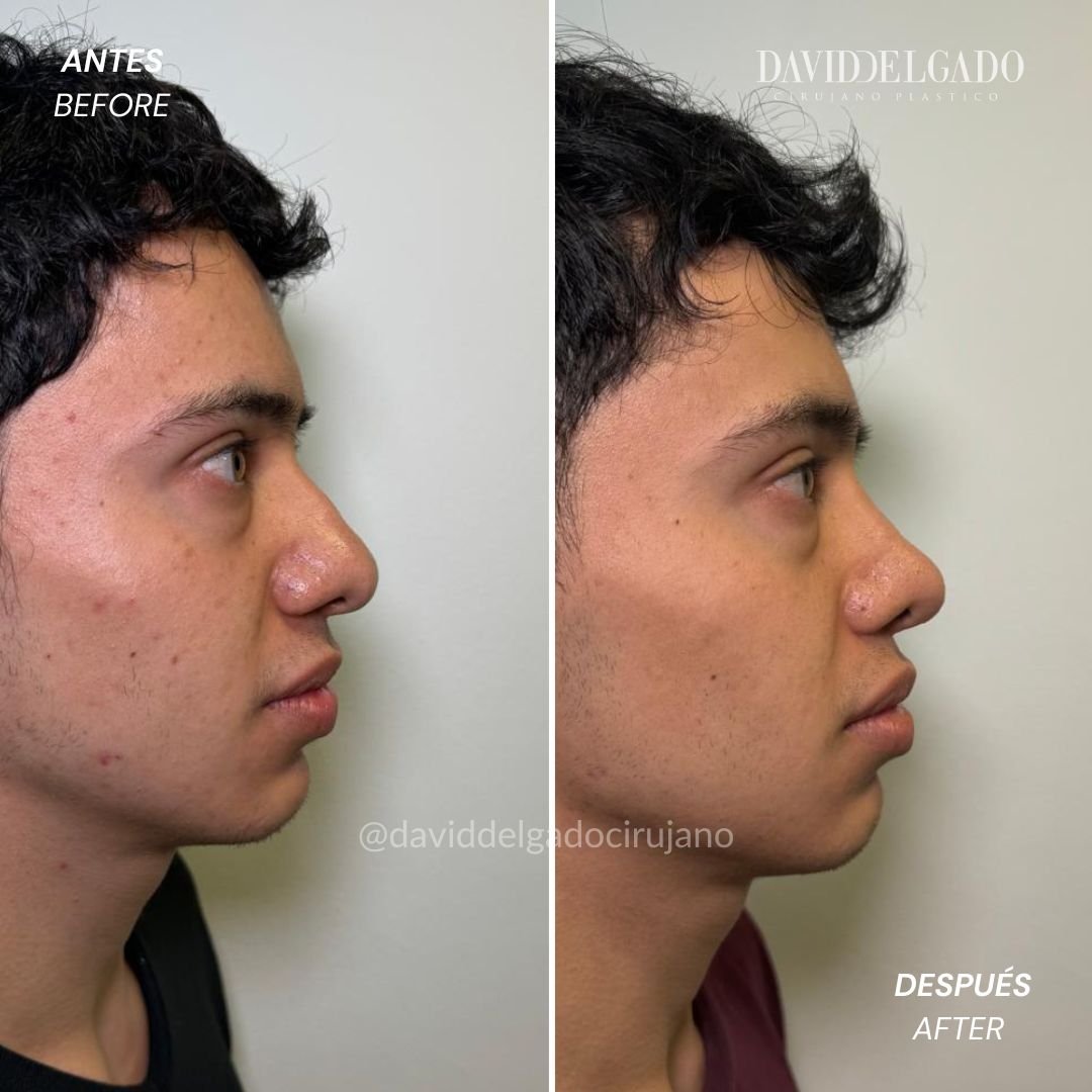Antes y después caso Rinoplastia Ultrasónica con el Dr David Delgado el Mejor Cirujano Plástico de Colombia