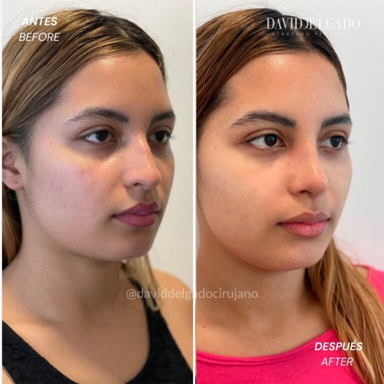 Antes y después Rinoplastia