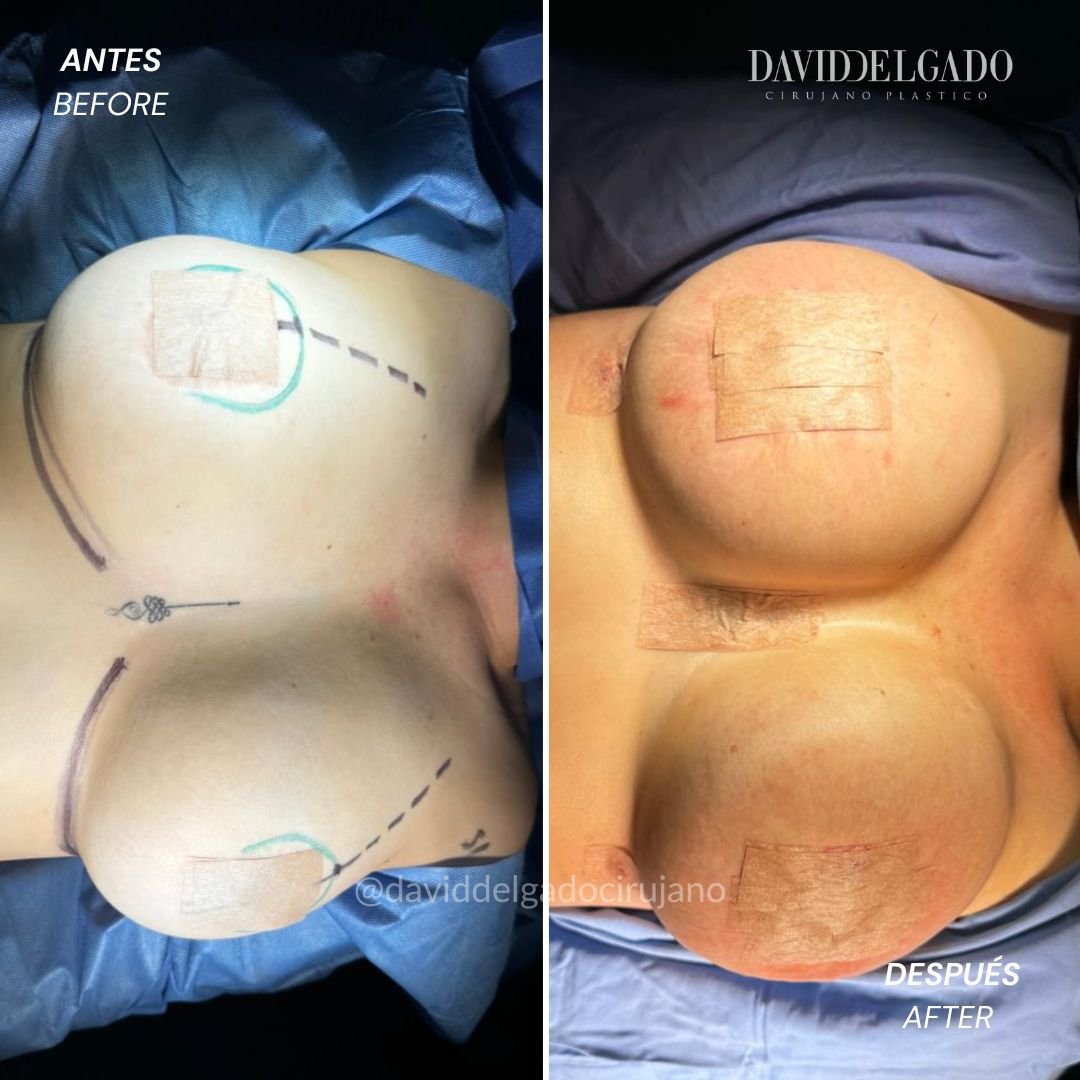 Mastopexia con cambio de implantes Antes y después