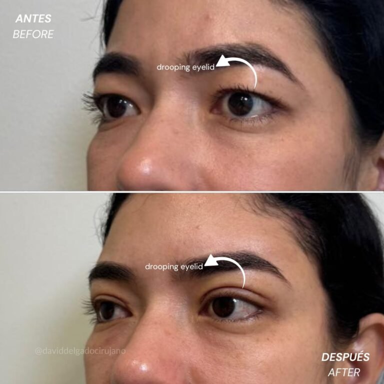 Antes y después Blefaroplastia con el Dr David Delgado el Mejor cirujano plástico de Medellín