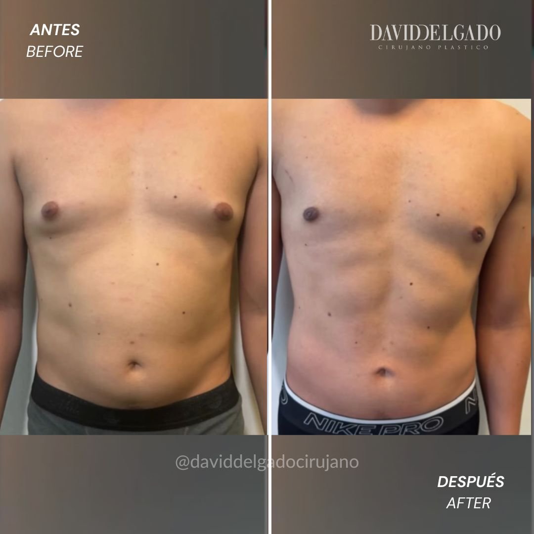 Antes y después Marcación abdomnal y corrección de ginecomastia - Dr. David delgado Cirujano Plástico en Medellín