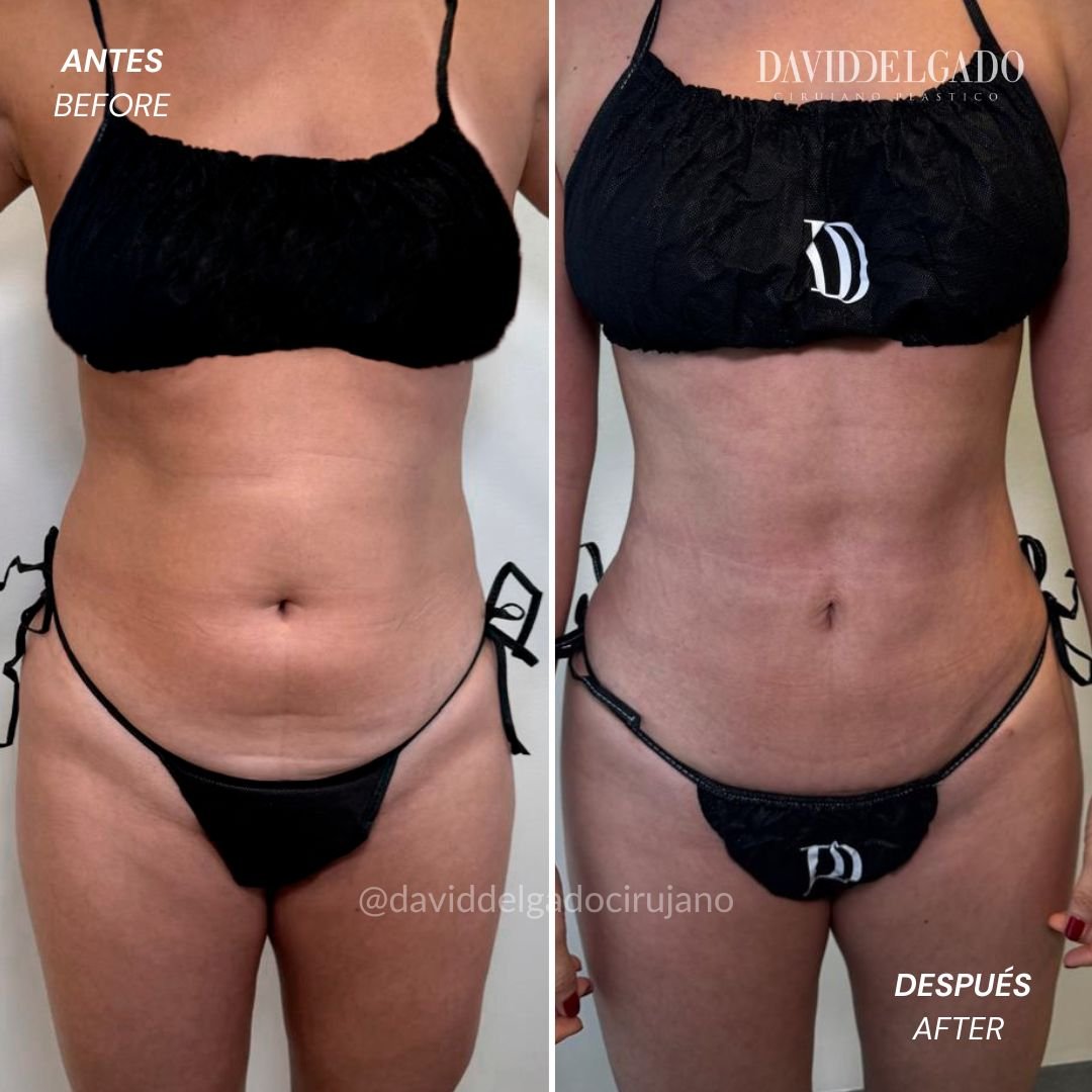 Antes y después Procedimientos de Liposucción Medellín, Colombia