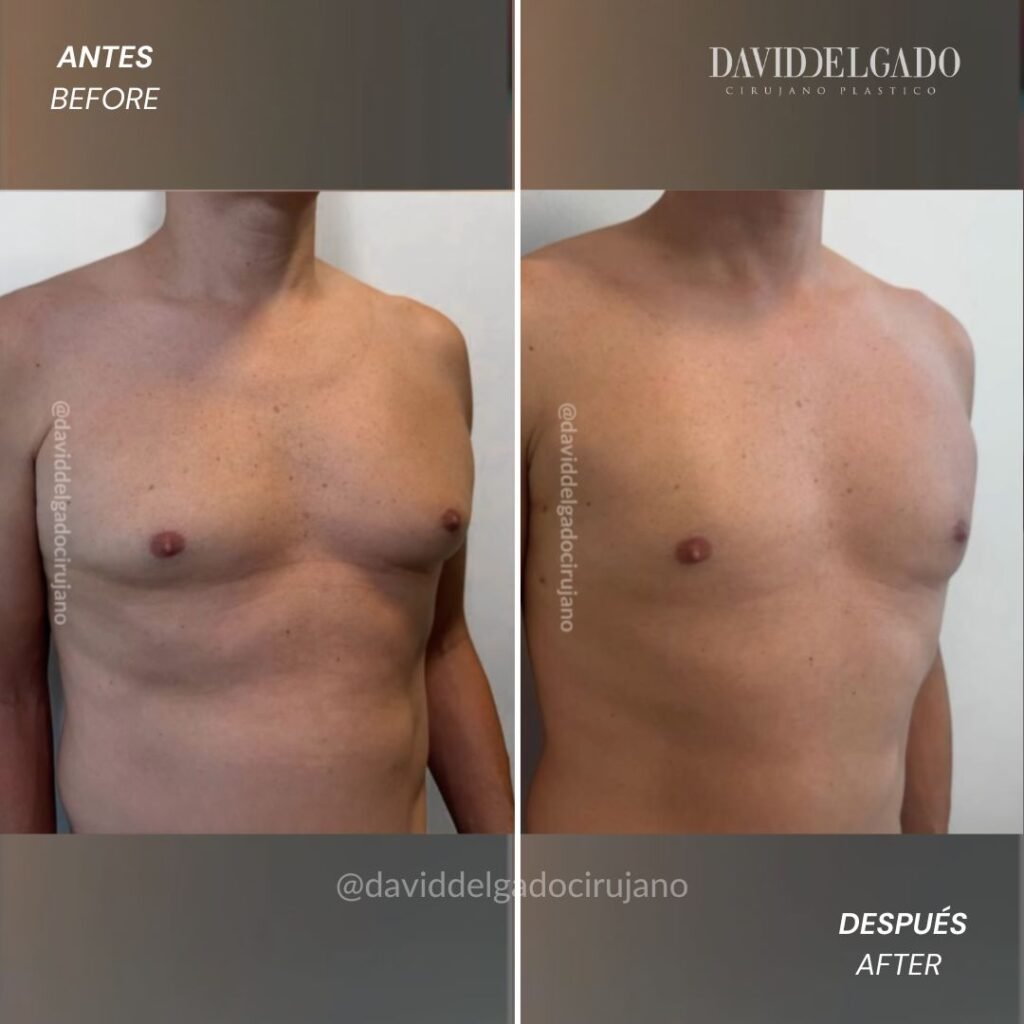 ginecomastia en Medellín | David Delgado Cirujano