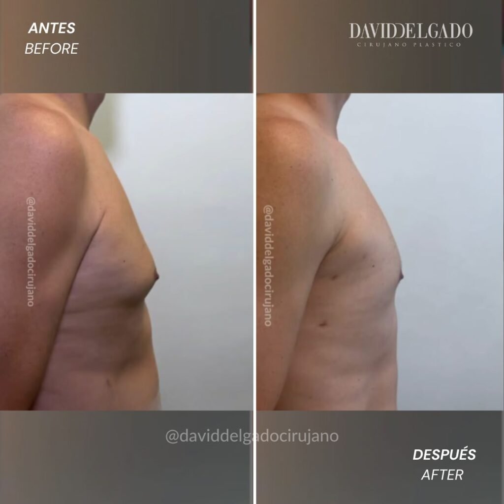 ginecomastia en Medellín | David Delgado Cirujano