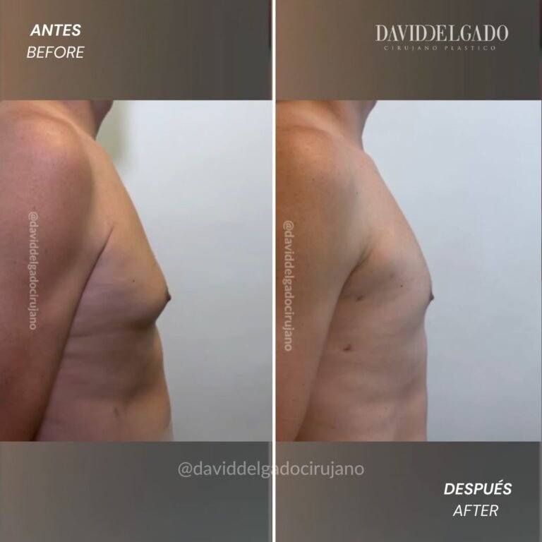 ginecomastia en Medellín | David Delgado Cirujano