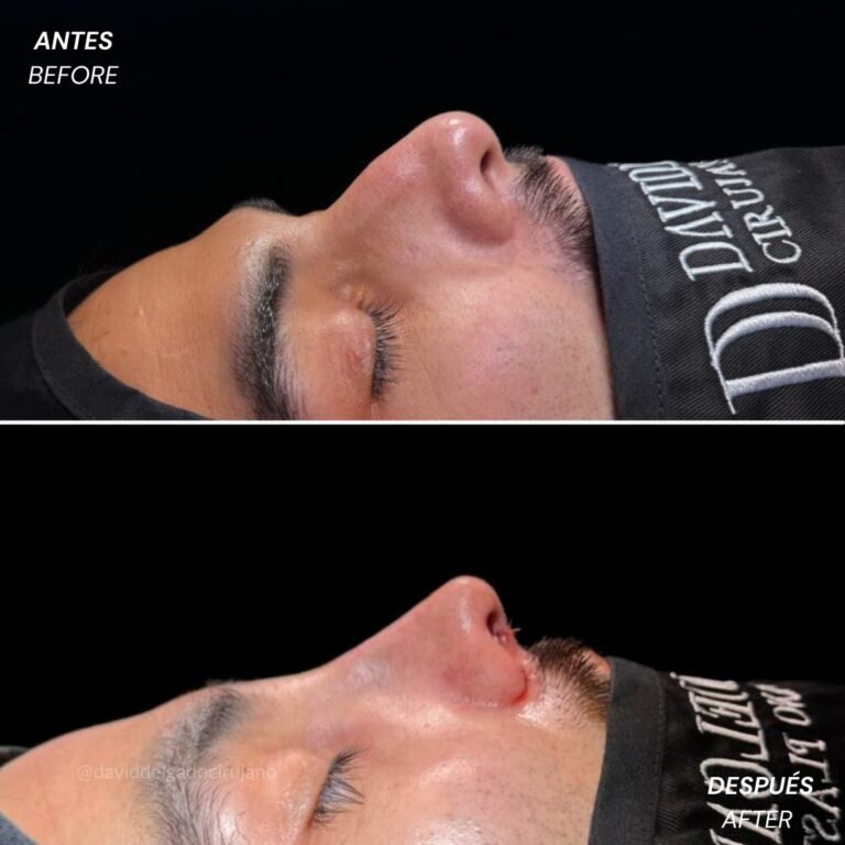 Antes y después Rinoplastia Ultrasónica Dr. David delgado Cirujano Plástico en Medellín