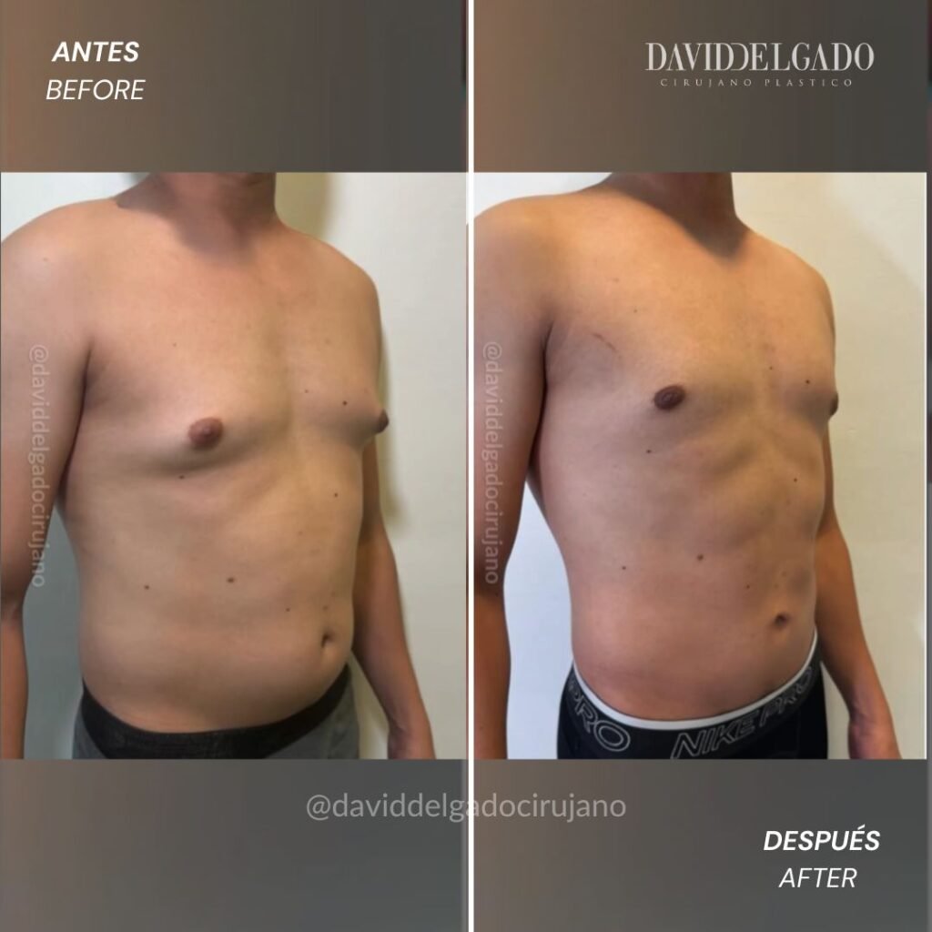 ginecomastia en Medellín | David Delgado Cirujano