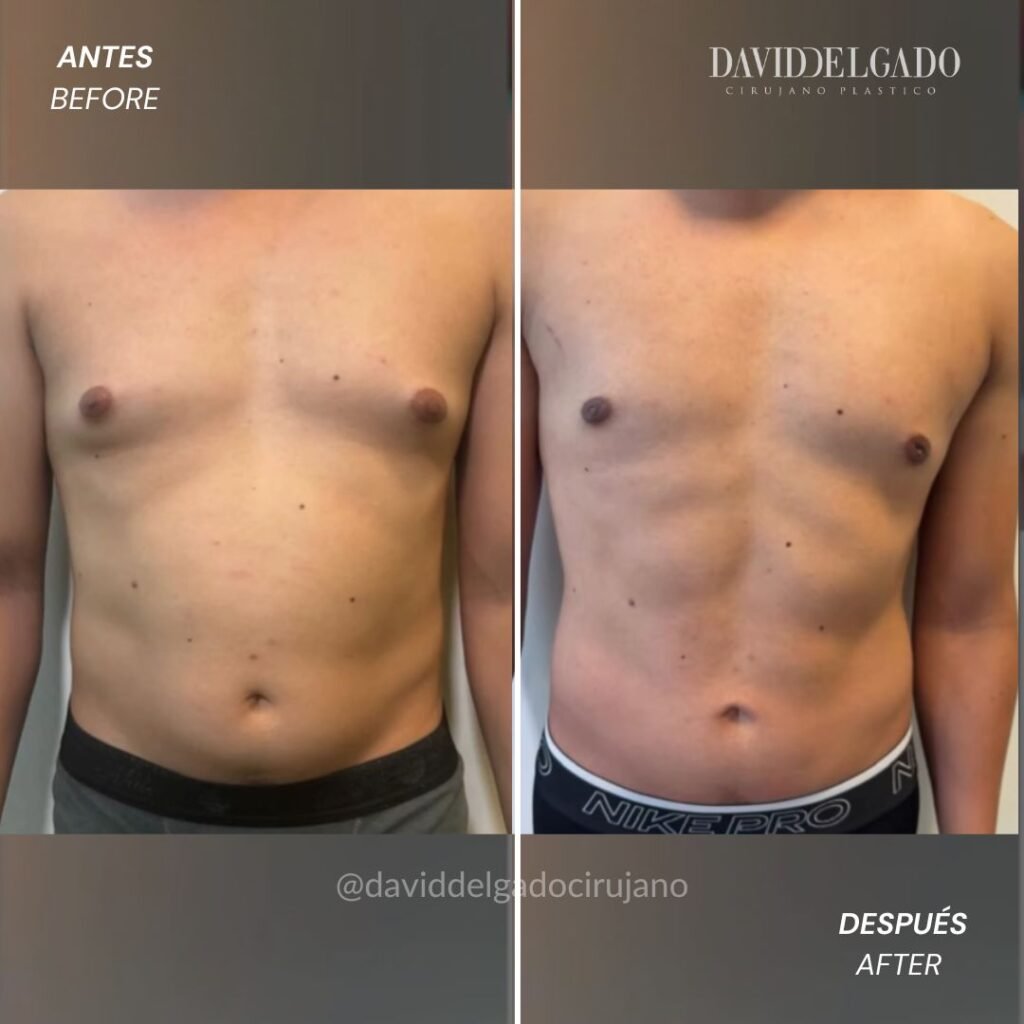 ginecomastia en Medellín | David Delgado Cirujano