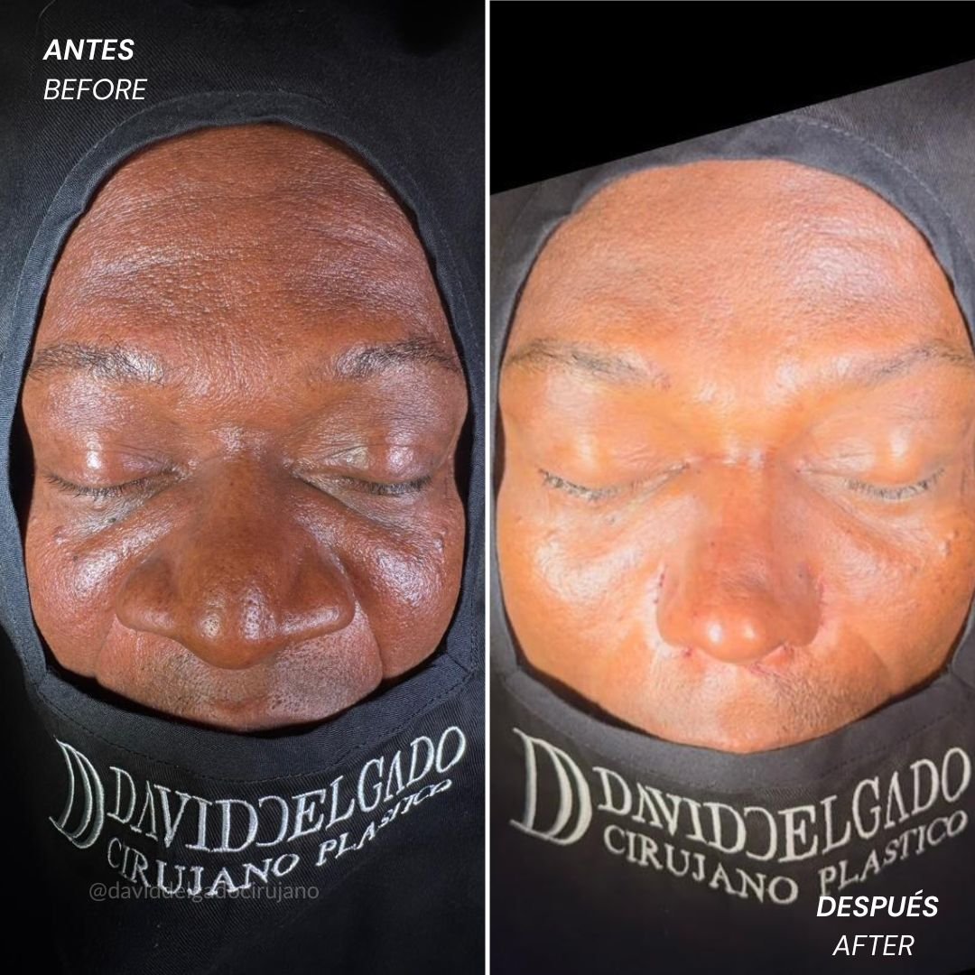 Antes y después Rinoplastia Dr. David delgado Cirujano Plástico en Medellín