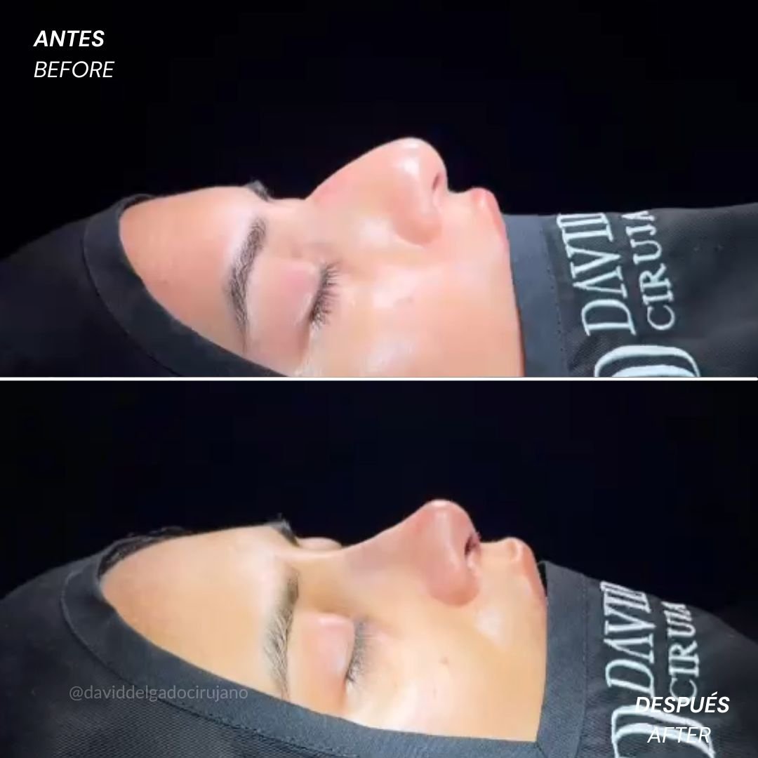 Antes y después Rinoplastia Ultrasónica Dr. David delgado Cirujano Plástico en Medellín