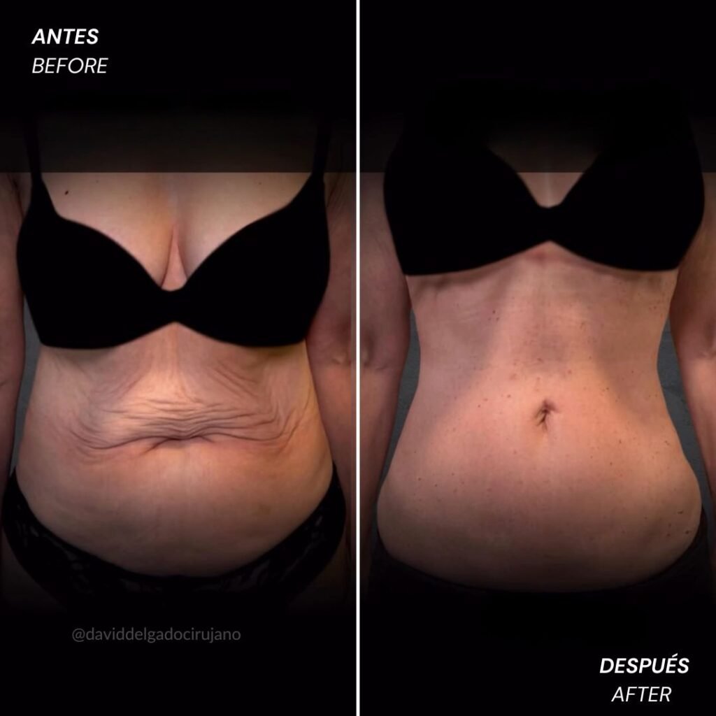 Antes y después Dr. David Delgado Abdominoplastia en reversa