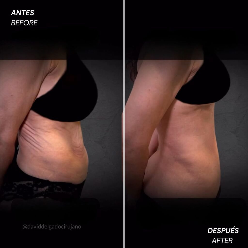 Antes y después Dr. David Delgado Abdominoplastia en reversa