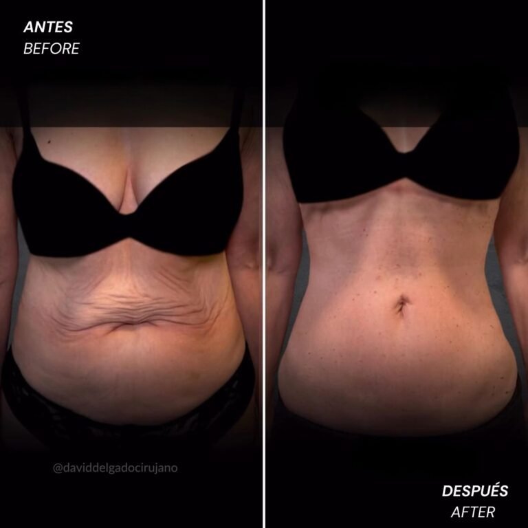 Antes y después Dr. David Delgado Abdominoplastia en reversa