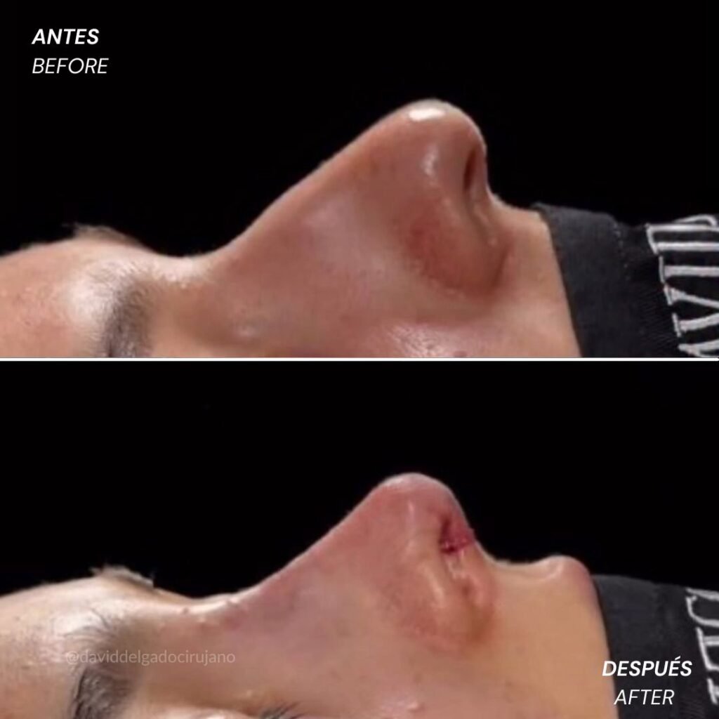 Antes y después Dr. David Delgado Rinoplastia