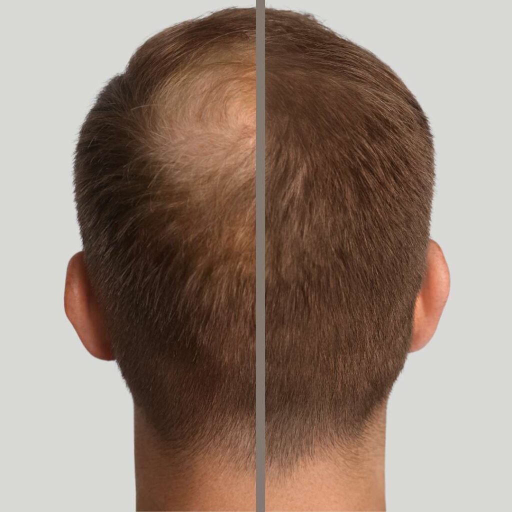 Implante capilar antes y después 1 - Dr. David Delgado - Clínica Be Dharma Hair - Medellín, Colombia