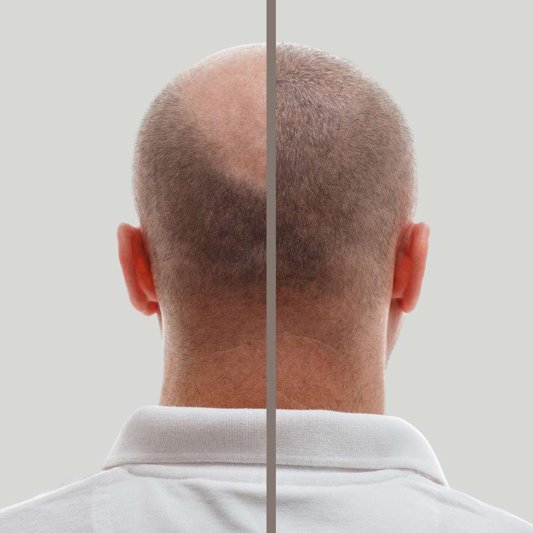 Implante capilar antes y después 2 - Dr. David Delgado - Clínica Be Dharma Hair - Medellín, Colombia