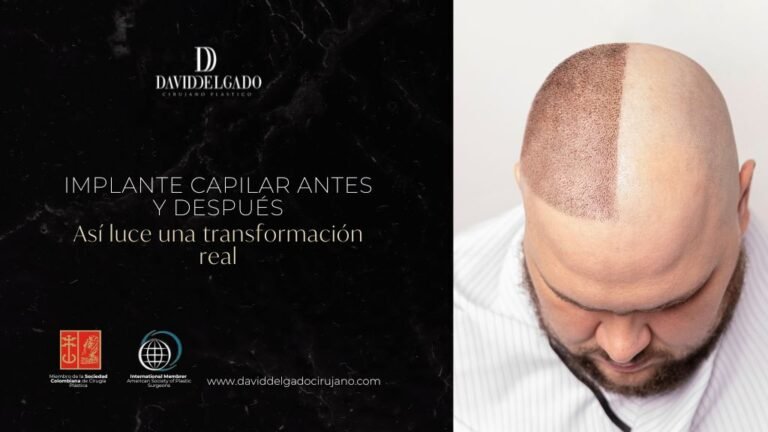 Implante capilar antes y después en la Clínica Be Dharma Hair - Dr. David Delgado