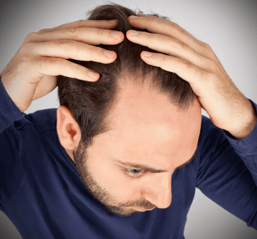 ¿Por qué se cae el cabello Las causas más comunes