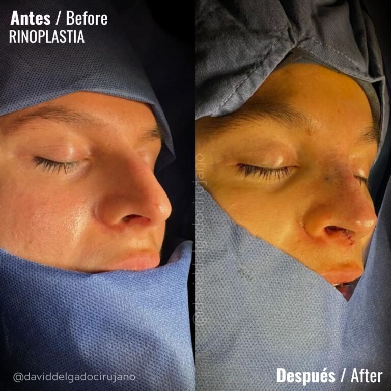 Rinoplastia antes y después - Dr. David Delgado - Cirujano plástico en Colombia