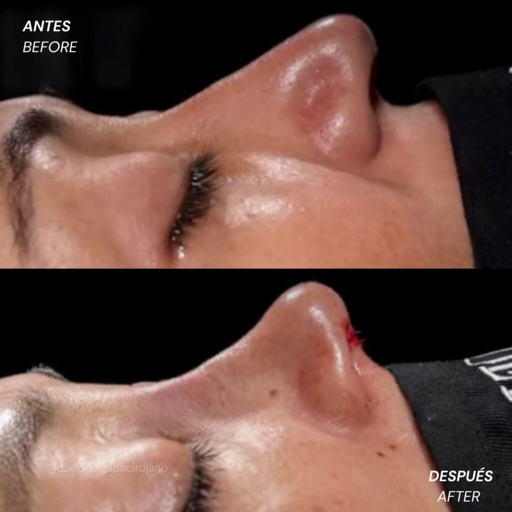 Rinoplastia antes y después con el cirujano plástico de Medellín David delgado