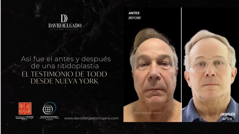 Ritidoplastia antes y después con el cirujano plástico de Medellín David Delgado