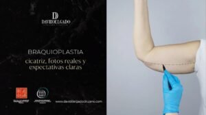 braquioplastia cicatriz fotos-Dr. David Delgado
