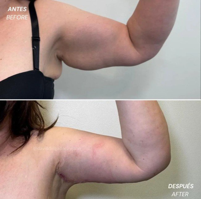 Braquioplastia antes y después - Cirujano plástico de Medellín David Delgado 2
