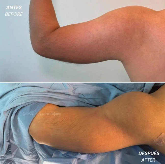 Braquioplastia antes y después - Cirujano plástico de Medellín David Delgado 3