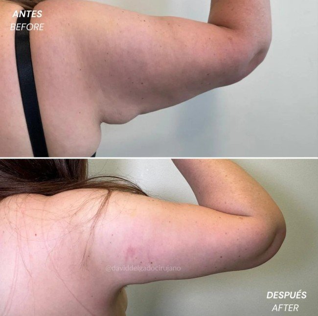 Braquioplastia antes y después - Cirujano plástico de Medellín David Delgado