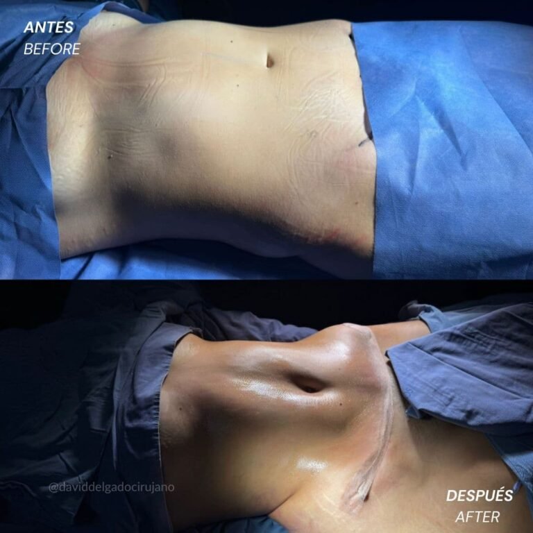 Liposucción antes y después con el cirujano plástico de Medellín David delgado - 011225