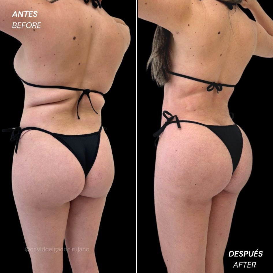 Liposucción 360 en Colombia - Caso de Antes y después - Dr. David Delgado Cirujano Plástico en Medellín - Plastic Surgery Medellín -