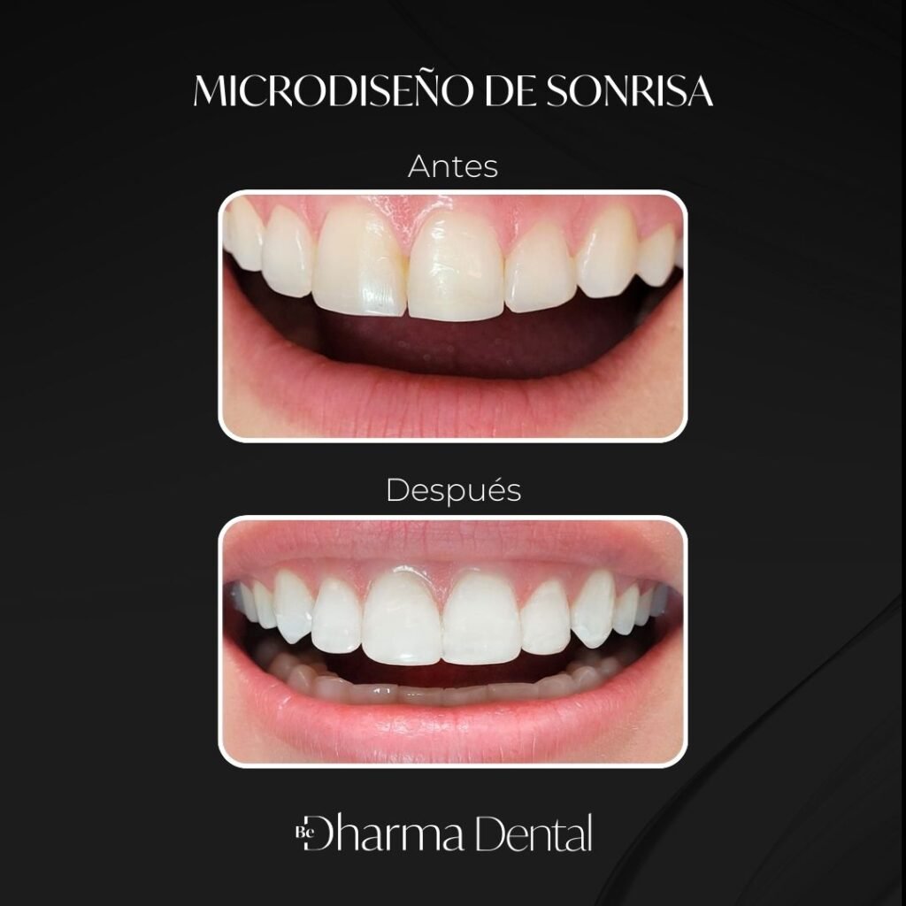 Microdiseño de sonrisa y diseño de Sonrisa en Medellín - Be Dharma Dental