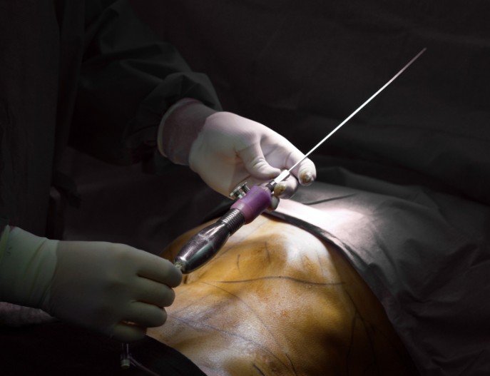 lipotransferencia para hombres - Cirugía plástica para hombres - Dr. David Delgado