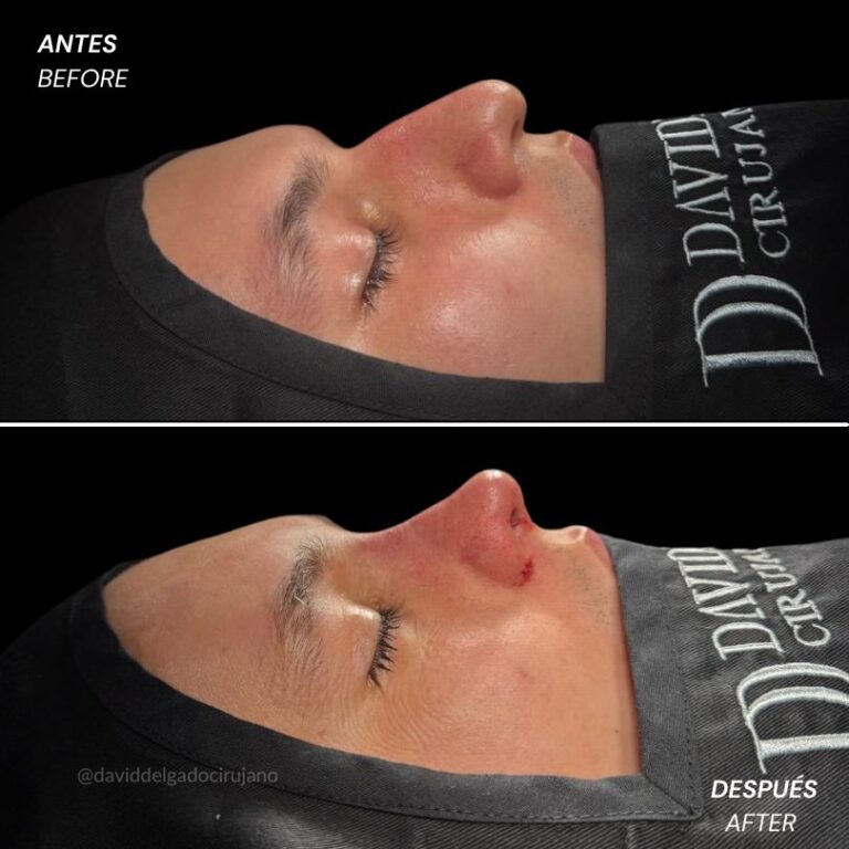 Rinoplastia ultrasónica en Medellín - Dr. David Delgado - Cirujano Plástico en Medellín